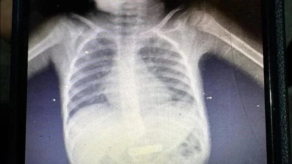 استخراج بطارية من معدة طفل في بورسعيد