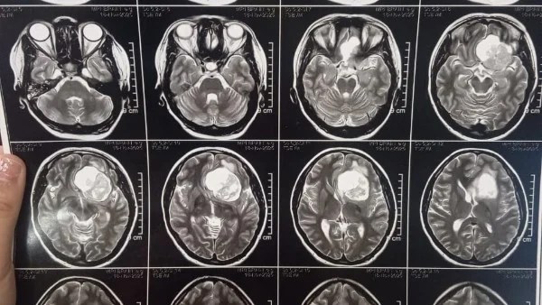 عملية جراحية معقدة لاستئصال ورم بقاع الجمجمة