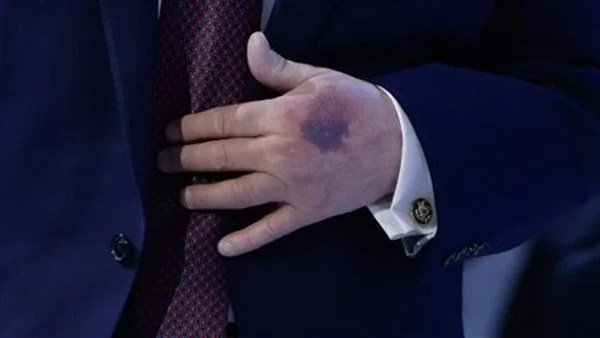 كدمات ترامب تثير القلق والبيت الأبيض يوضح الأسباب