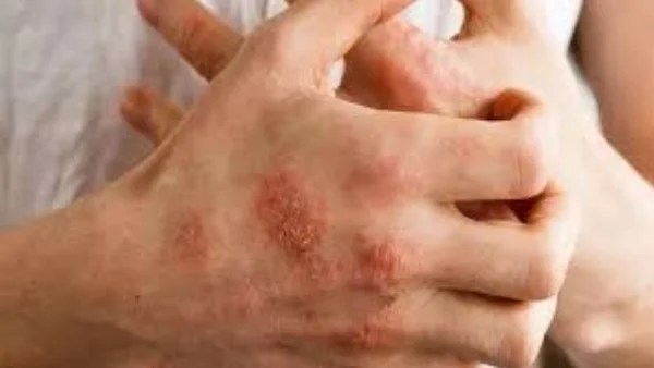 وصفات طبيعية لعلاج الإكزيما بفعالية