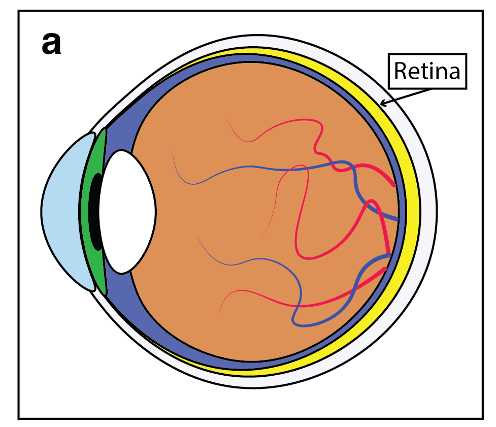 Treating Blindness with Combined CRISPR-Cas9/RecA 