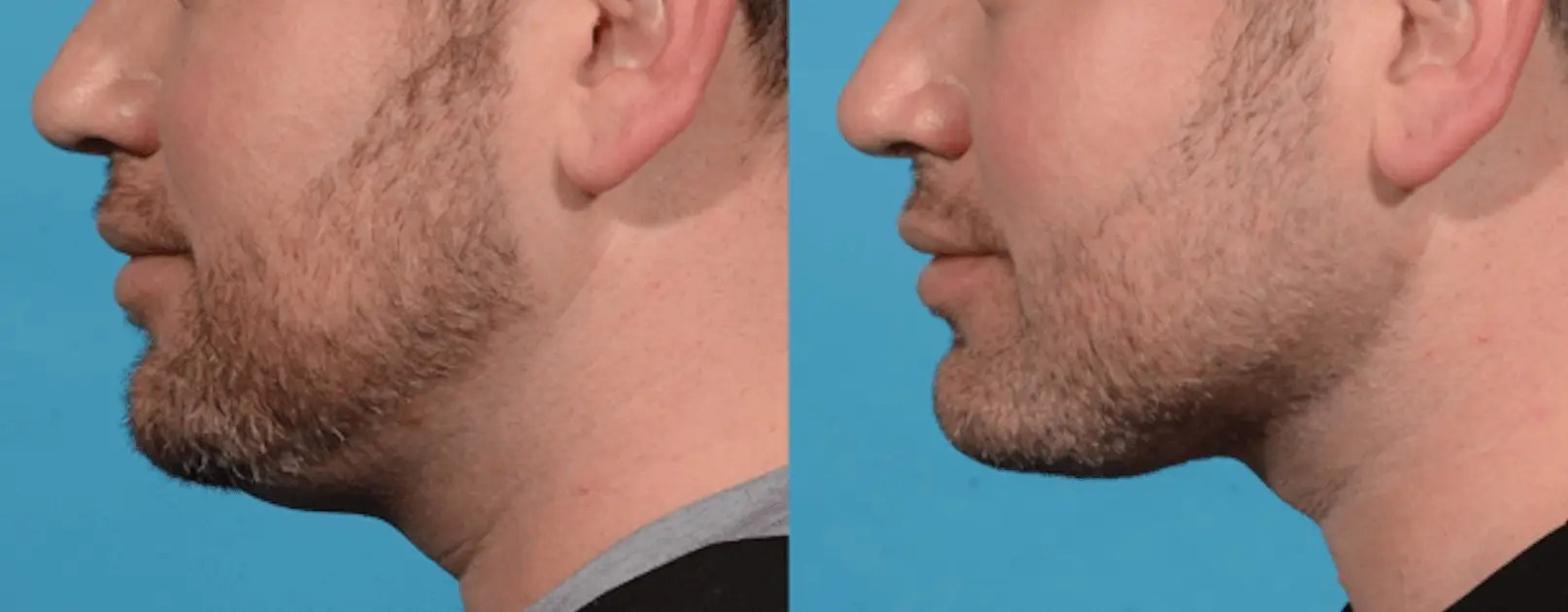 Evoke non-surgical facial treatments Scottsdale