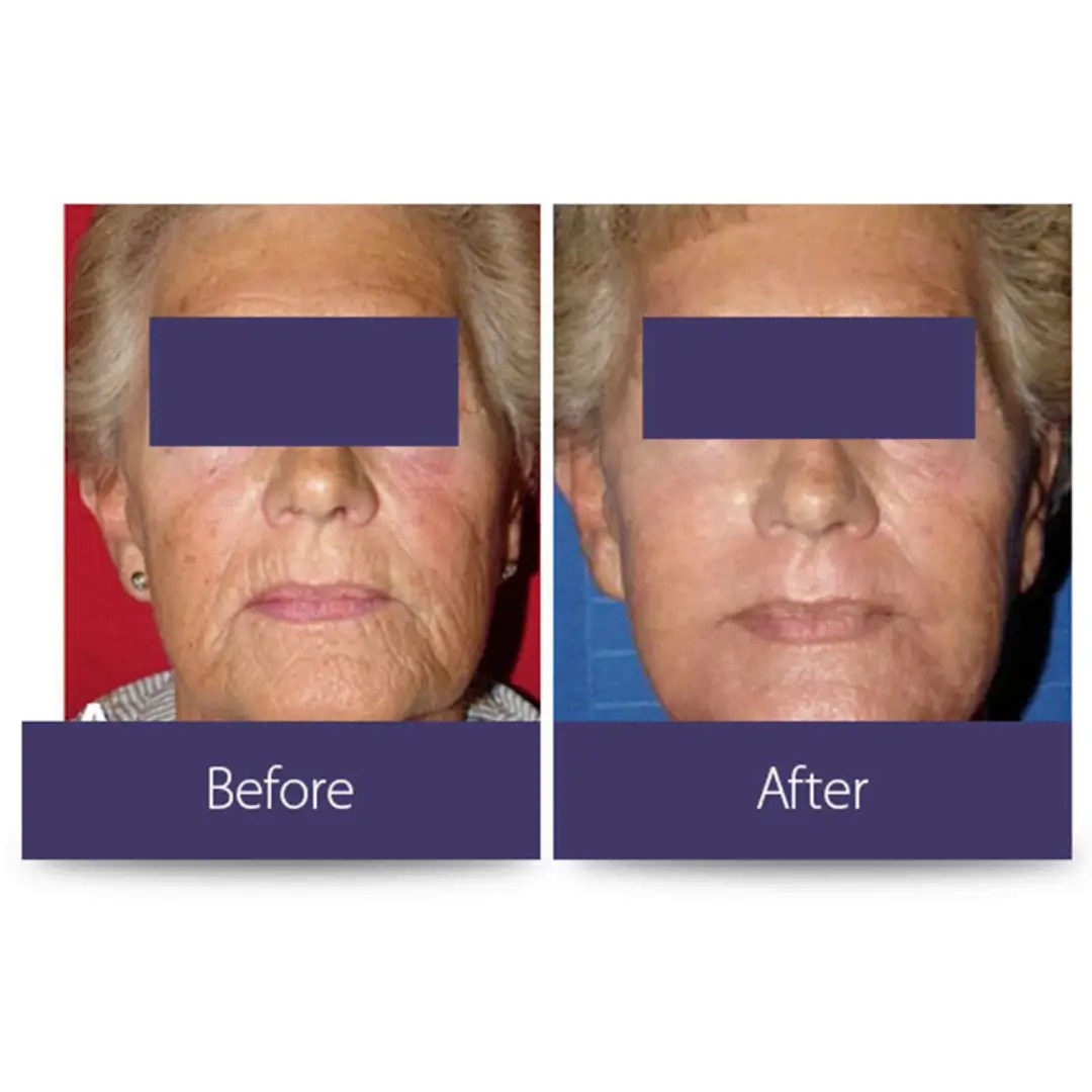 Laser skin resurfacing Scottsdale