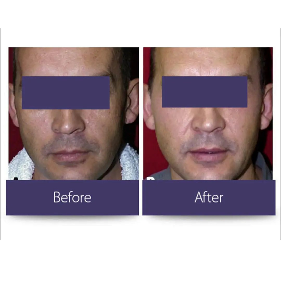 Laser skin resurfacing Scottsdale