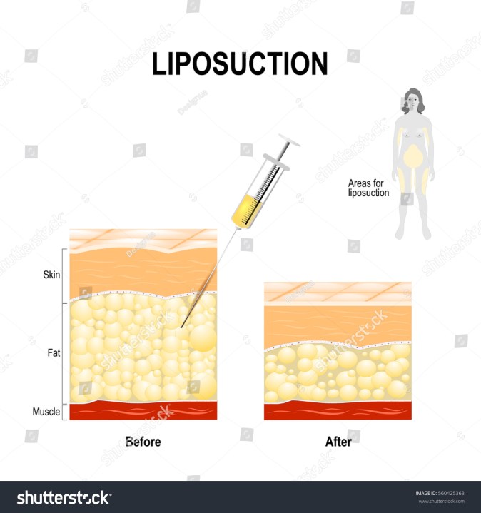 What are tumescent, traditional, highdefinition, 3D, 4D, 360, PAL, SAL