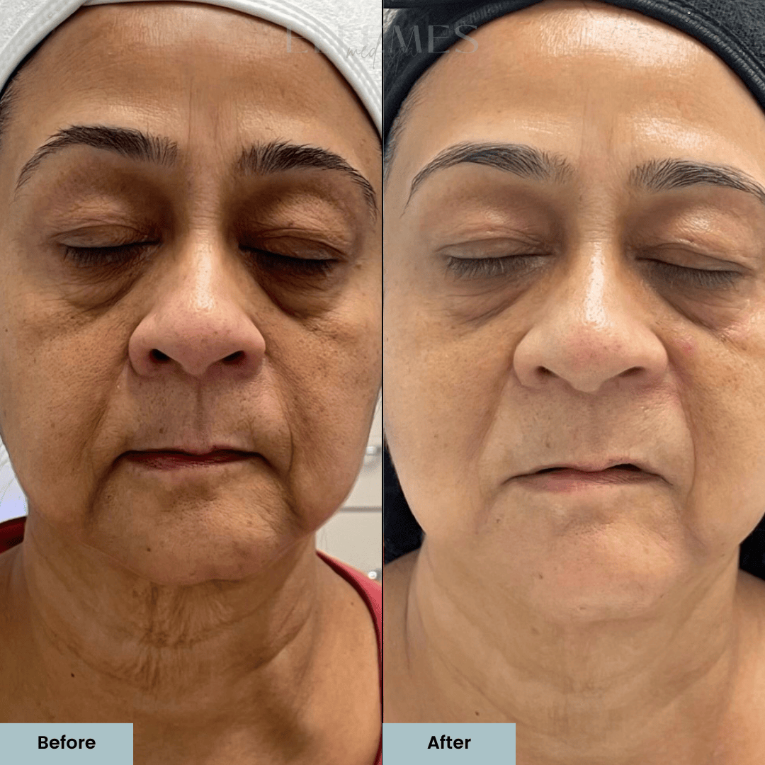 RF microneedling before and after results at ELLEMES Medical Spa Atlanta