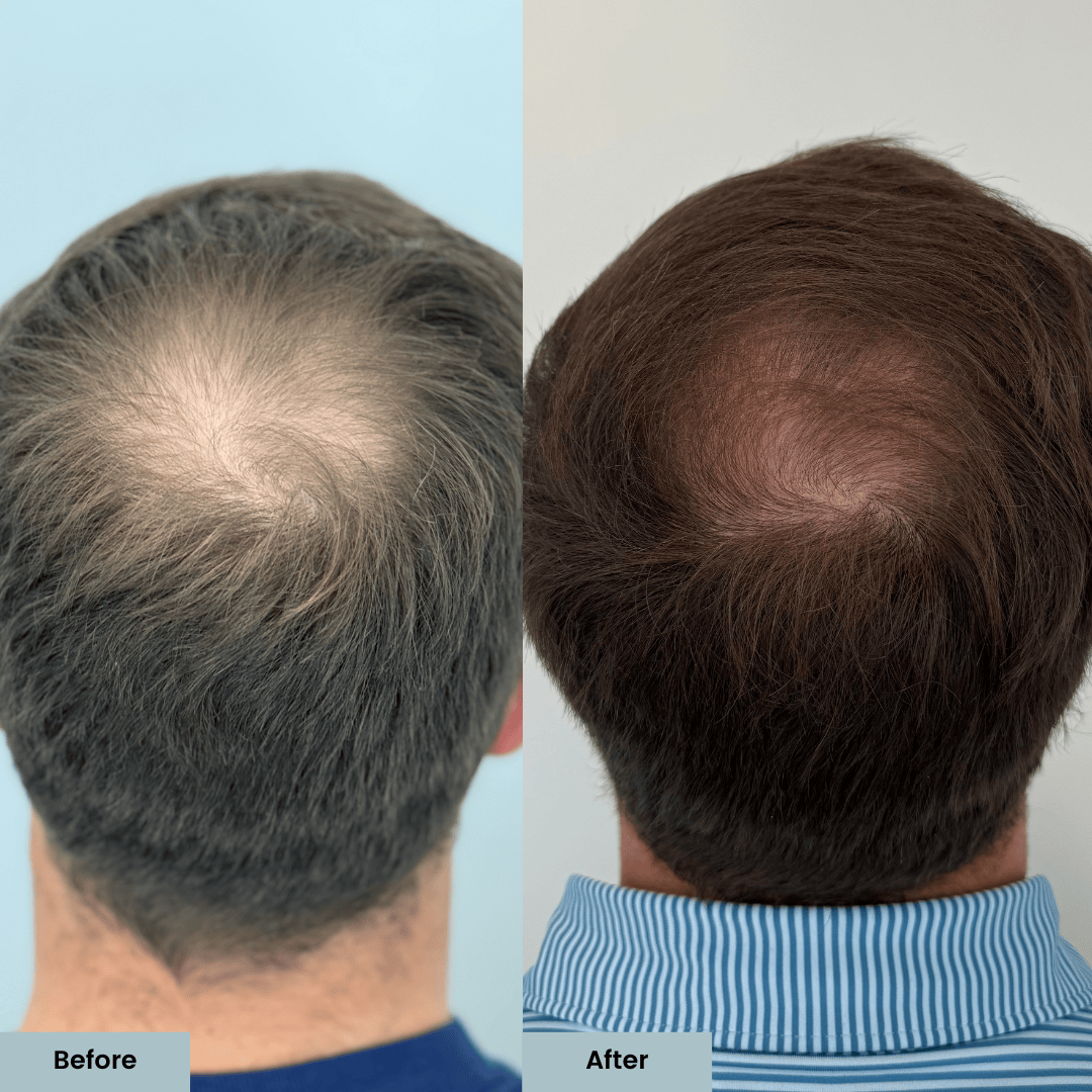 Hair restoration before and after results at ELLEMES Medical Spa Atlanta