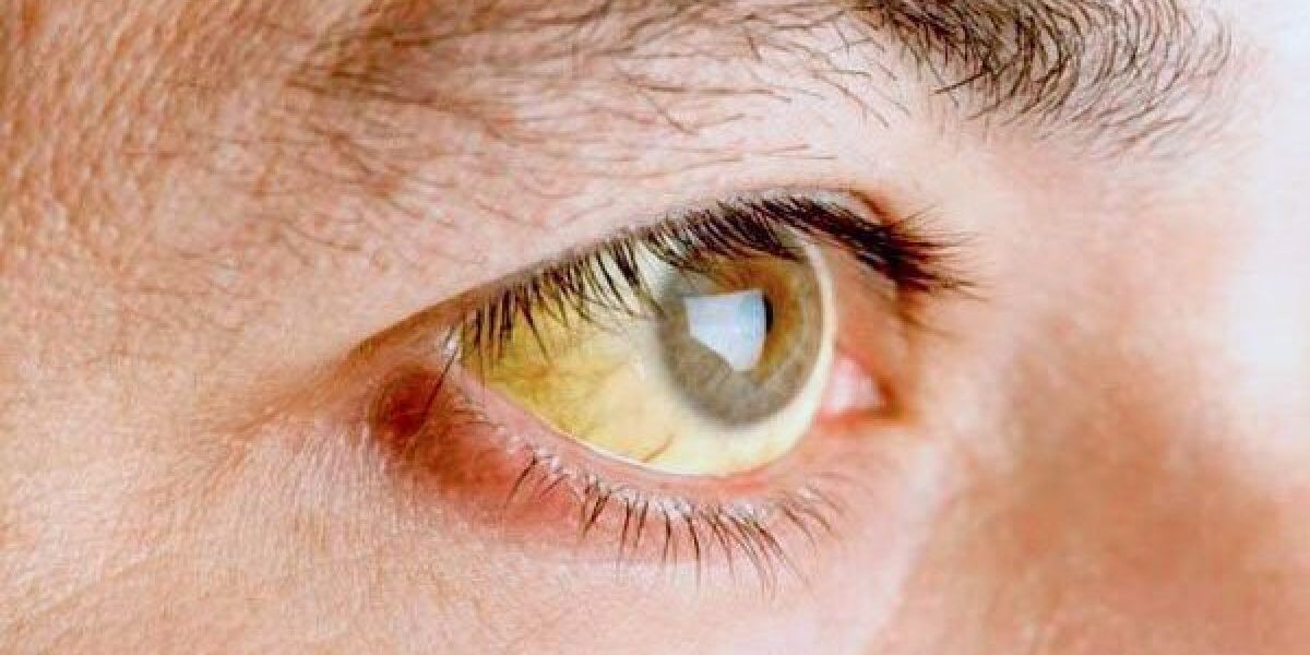 Imagen relacionada con: Lanzan plan para eliminar la hepatitis viral de cara al 2030