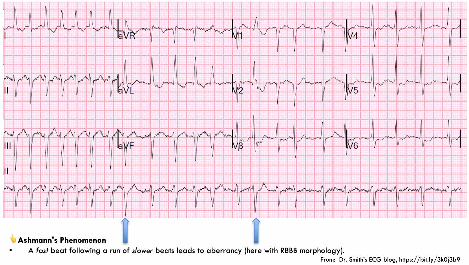 Supraventricular tachycardia (SVT) - EMCrit Project