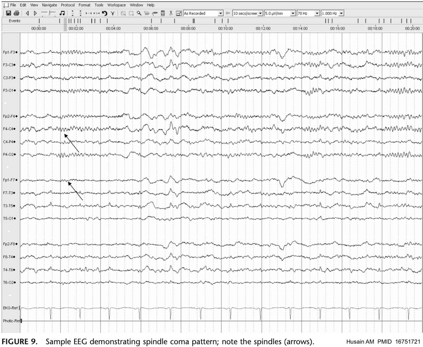EEG interpretation and ictal-interictal continuum - EMCrit Project