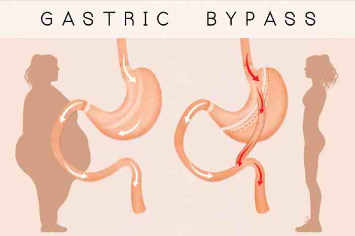 4 Gastric Bypass Complications Years Later - Weight Loss Surgery How to bypass android lock screen without losing data