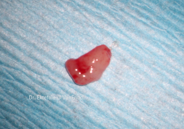 resorptive tissue excised