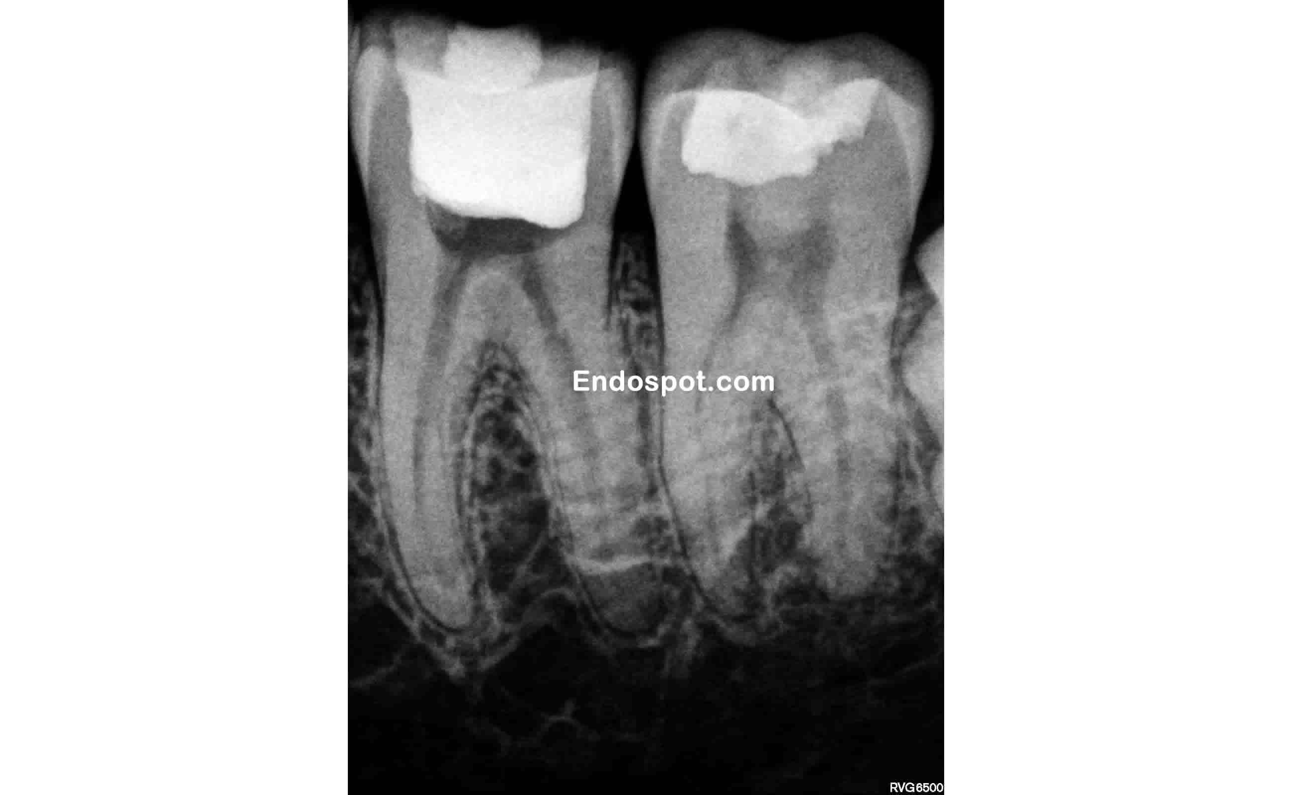 Endodontic Access for Conservationists. A How To Guide. the endospot