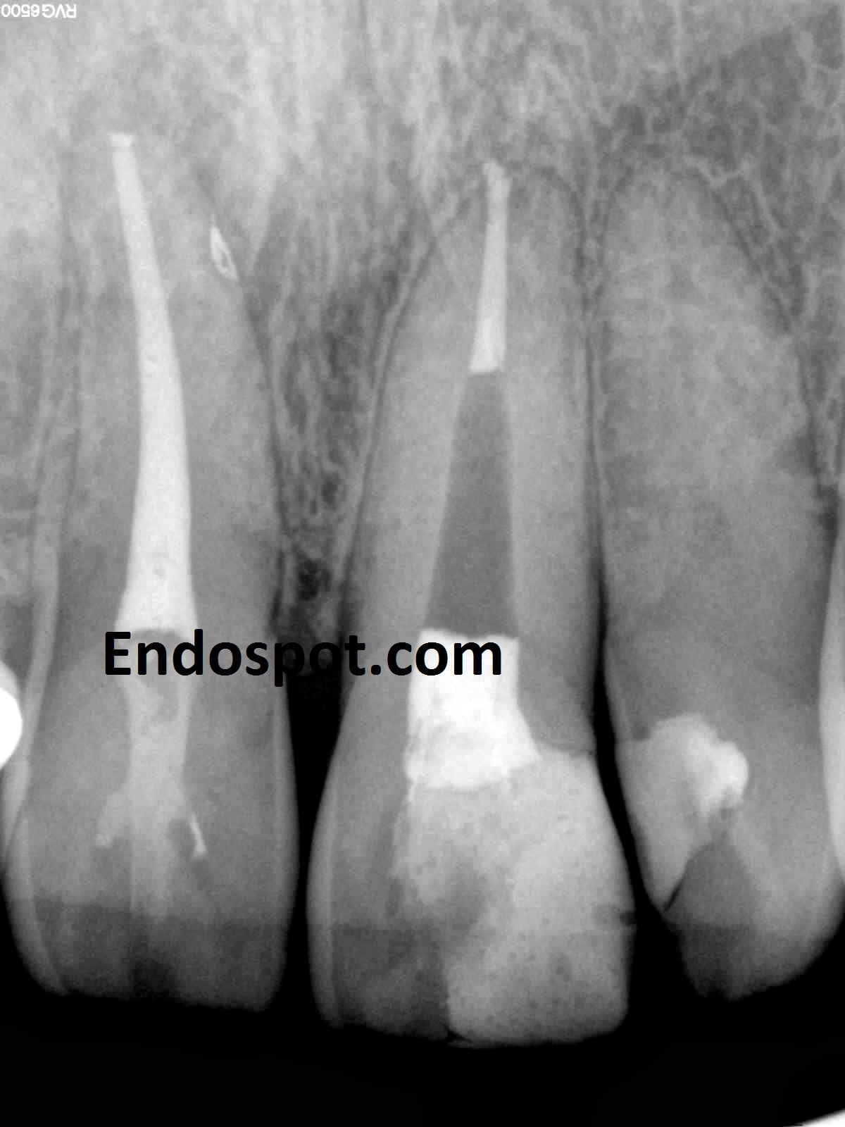 How Strong Can A Pulp Be? the endospot