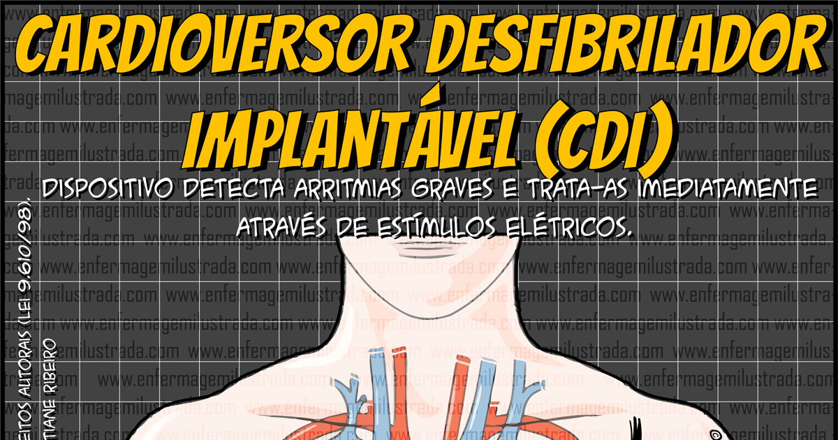 Cardioversor Desfibrilador Implantável (CDI)