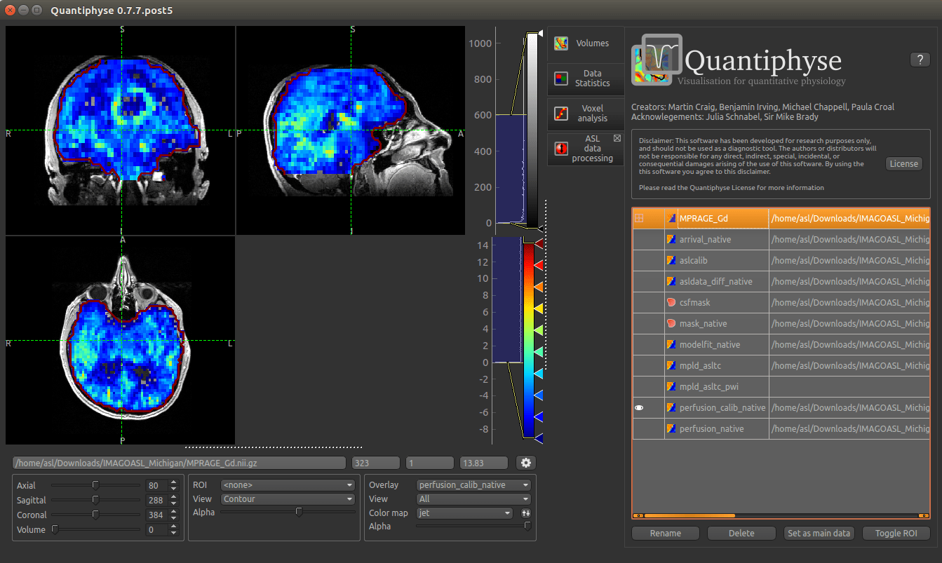Dynamic Susceptibility Contrast Perfusion Weighted And Diffusion - Premium Sunset Image Gallery - Retina