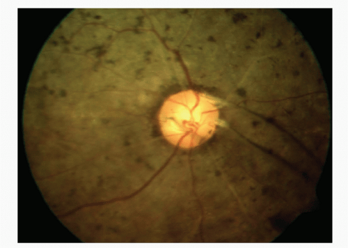 Artificial Vision | Ento Key