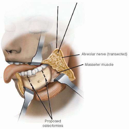 Lateral Segmental Mandibulectomy | Ento Key