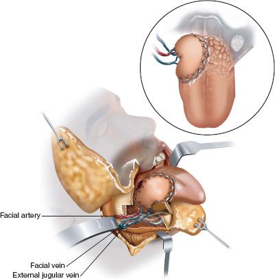 Management of the Defect of the Base of the Tongue | Ento Key