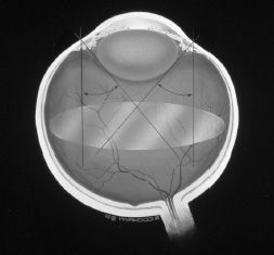 48 Surgical Approaches to Infant and Childhood Retinal Diseases ...