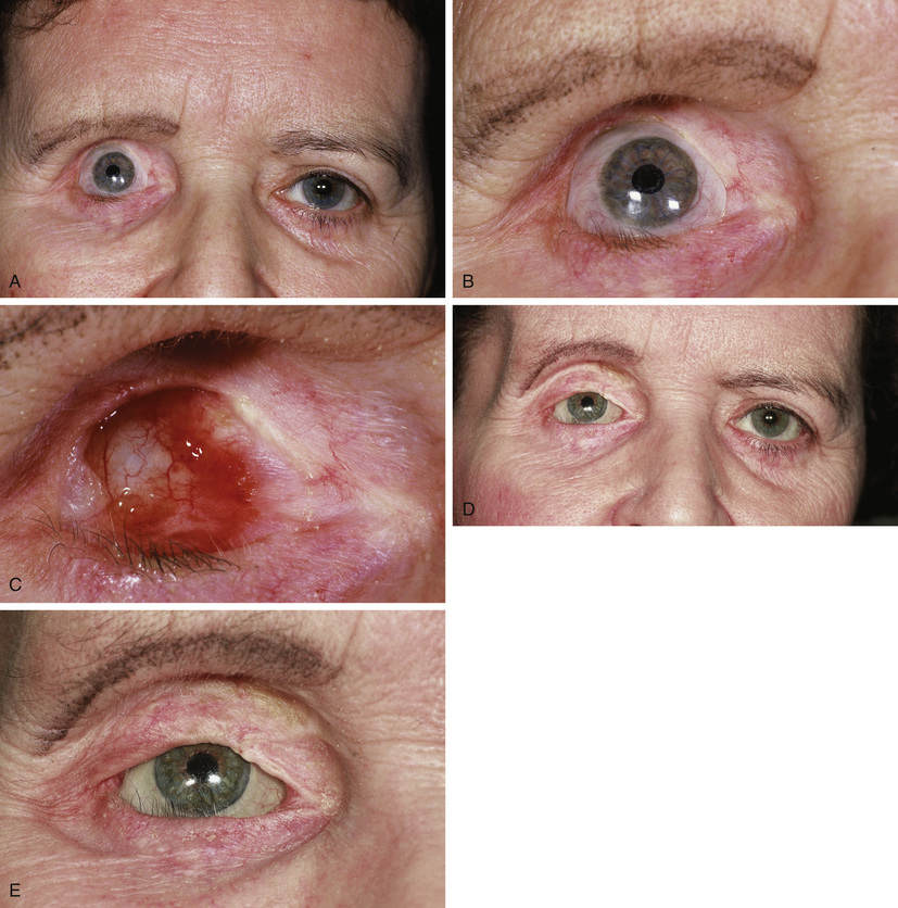 The Anophthalmic Socket and Complications Ento Key