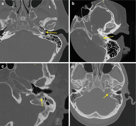 The Natural History of Jugular Paraganglioma | Ento Key