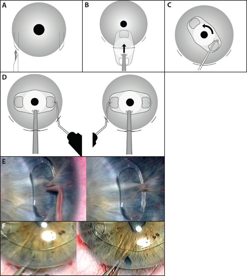 The Artisan Iris Claw Lens for Anterior Iris Fixation | Ento Key