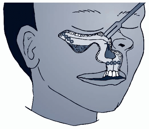 Surgical Technique | Ento Key