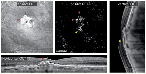 Dome-Shaped Macula | Ento Key