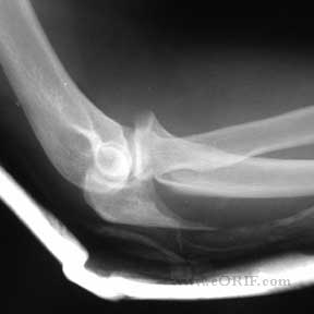 Open Reduction Internal Fixation Orif For Proximal Phalanx Base And Shaft Pilon Fractures Distal Biceps Tendon Rupture S46299A 8418.