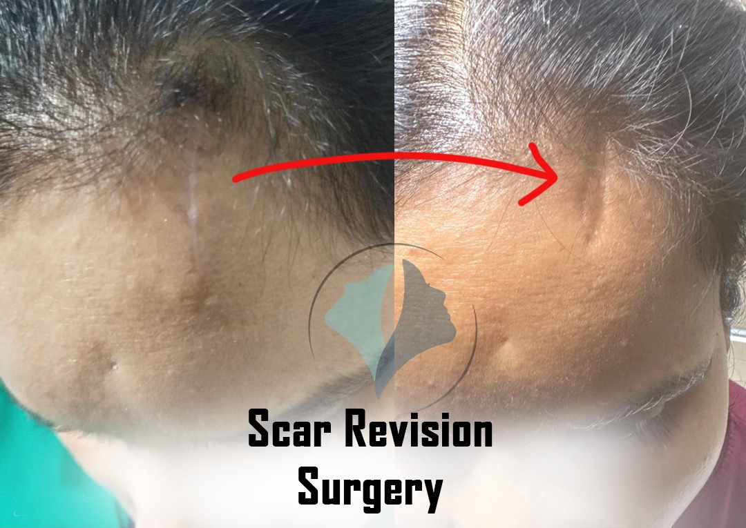 Scar revision Surgery