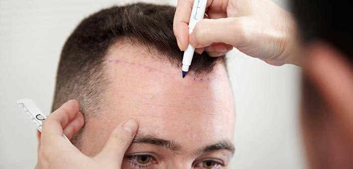 زراعة الشعر في تركيا
