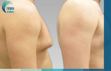 التثدي لدى الرجال