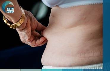 شد ترهلات الجسم