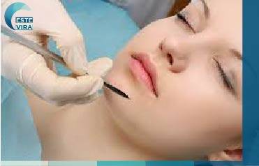 تجميل الذقن