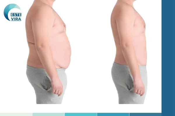 شفط الدهو بالليزر