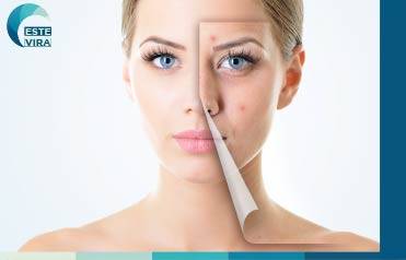 التقشير الكيميائي