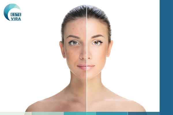 التقشير الكيميائي