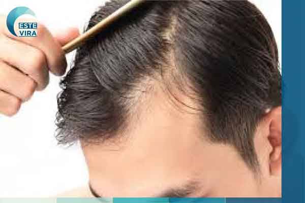 زراعة الشعر بقلم تشوي