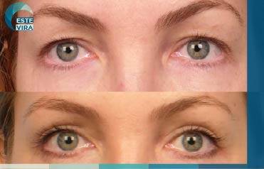 زراعة الحواجب