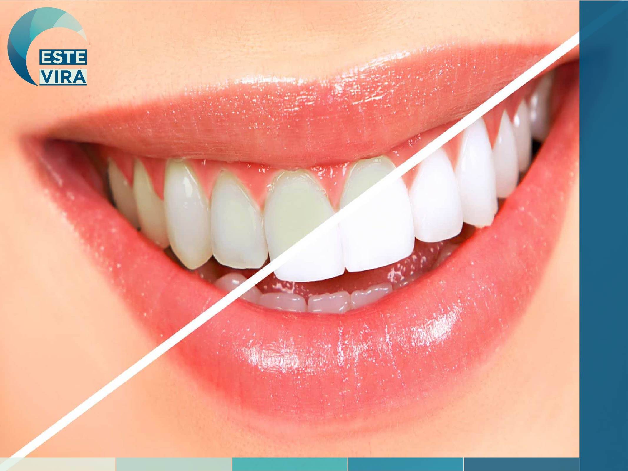 ابتسامة هوليود