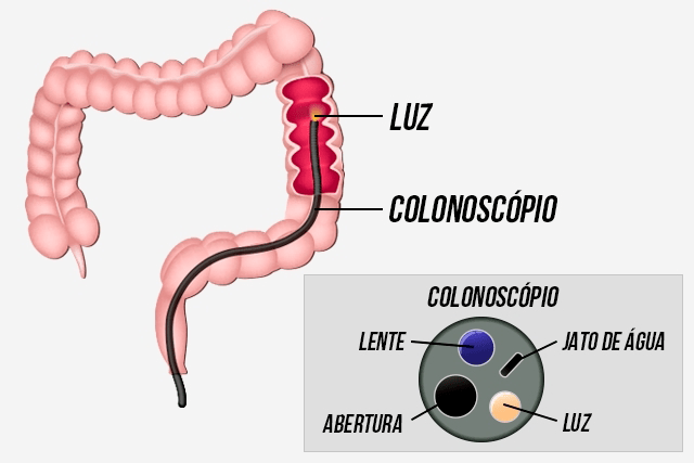 Colonoscopia com polipctomia e tatuagem Clinica De Gastrenterologia De Almada Posts Facebook