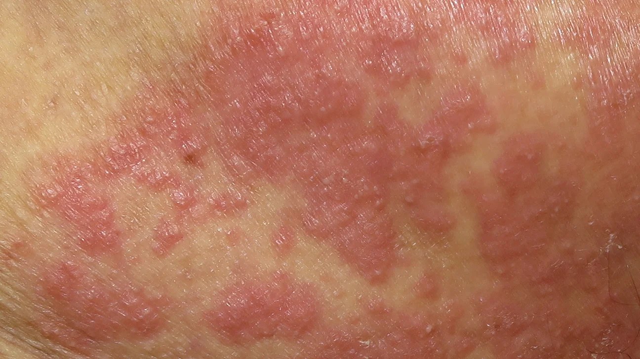 fungus on the face