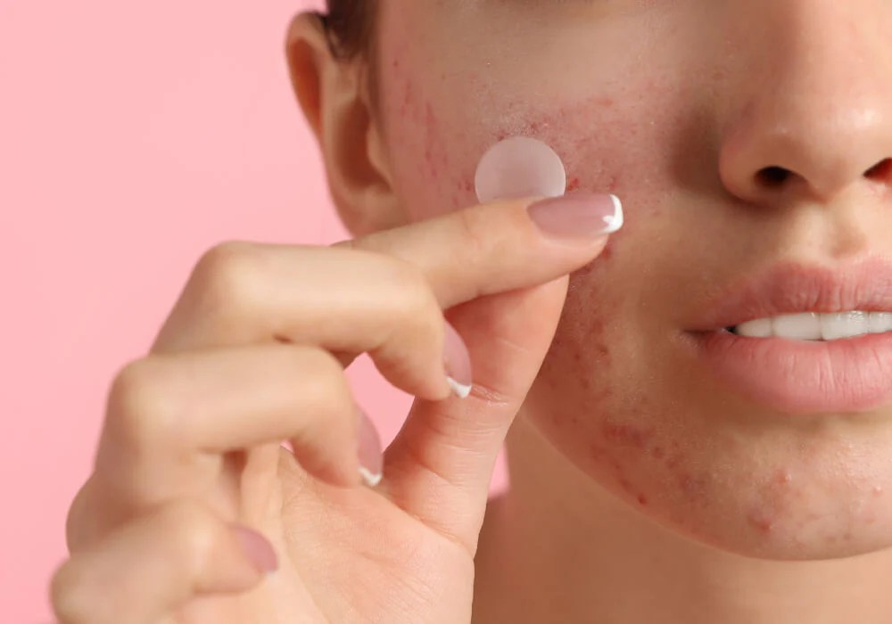 acne patch