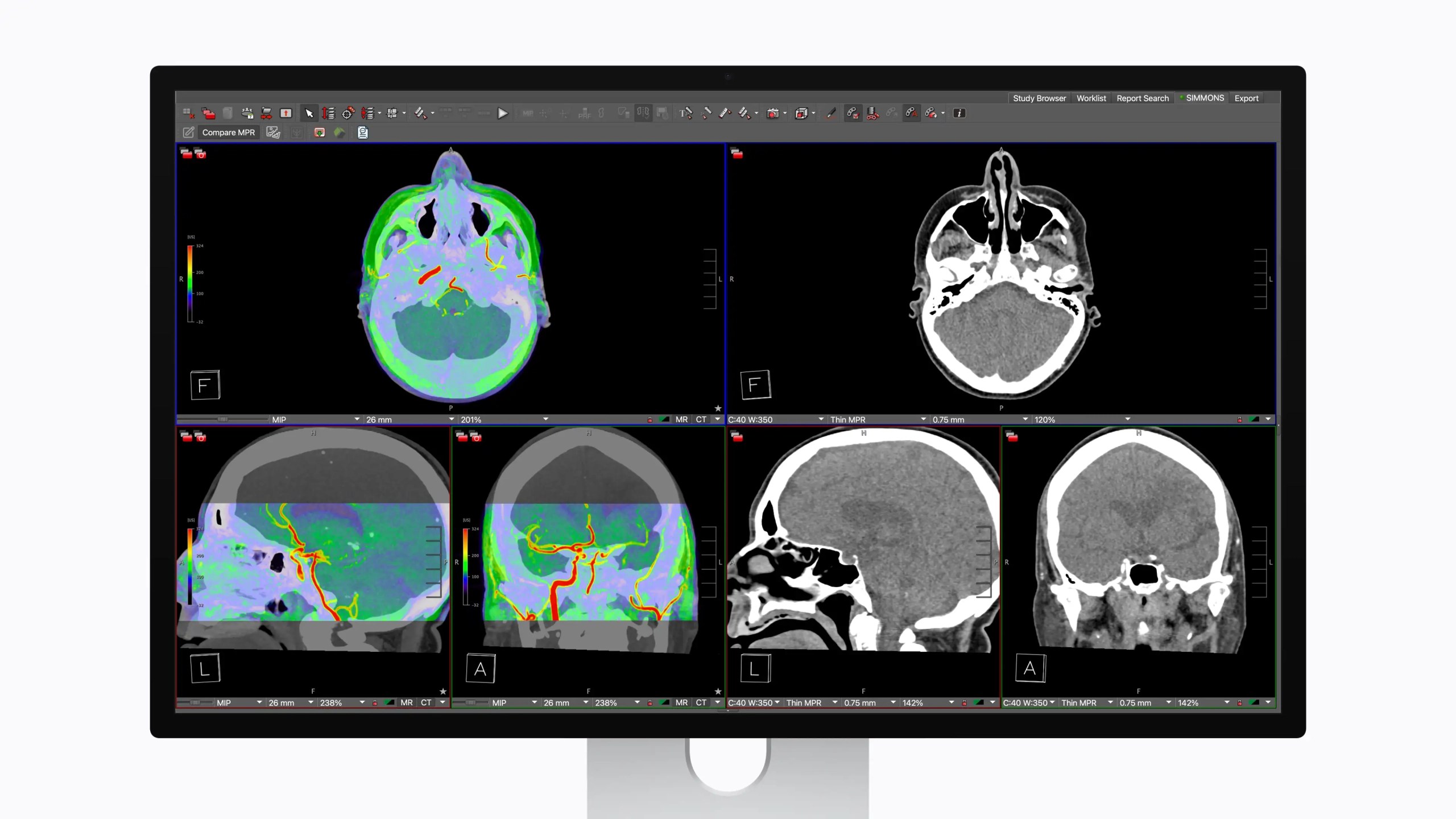 Medical imaging display showing multiple views of brain scans, including axial, coronal, and sagittal sections with color-coded overlays.