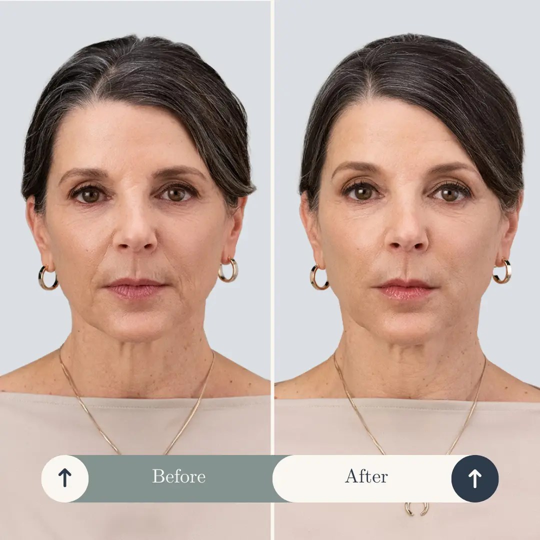 Woman before and after RHA dermal fillers