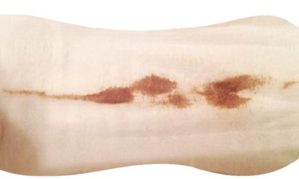 Why Is My Virginal Discharge Brown? 5 Virginal Infections You Should