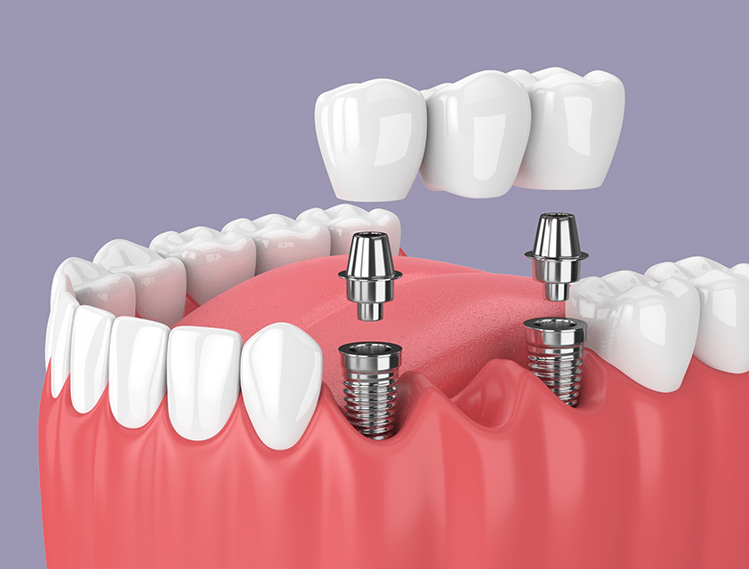 bridge dentaire expidental dental implant