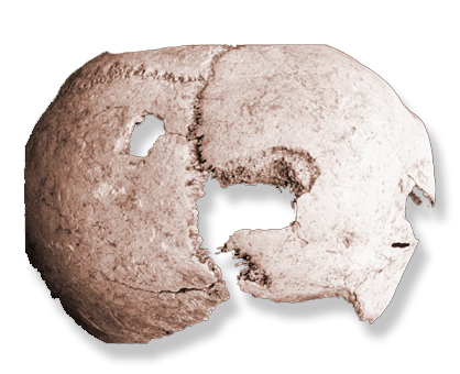 Partial human skull with large holes in the cranium.
