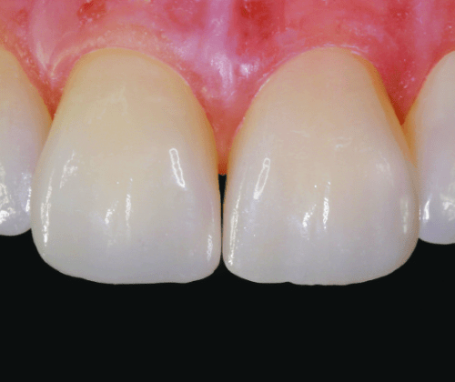 veneers